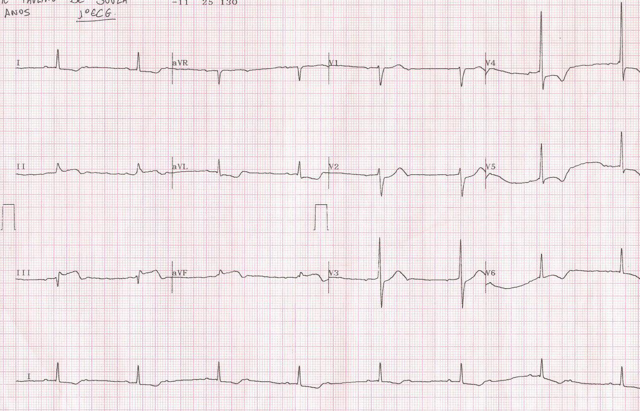Paciente de 77 años con SCA que presenta FV que es revertida por enfermedad de tres vasos
