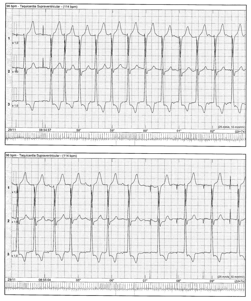 Portador de marcapasos que presenta palpitaciones por presencia de TPSV