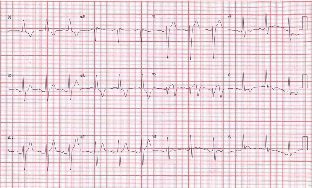 Hombre de 78 años hipertenso, IRC, con fiebre e hiperpotasemia que se corrige