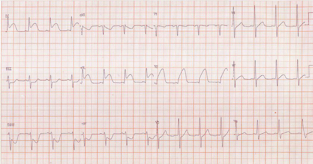 Paciente con SCACEST por compromiso de arteria Diagonal