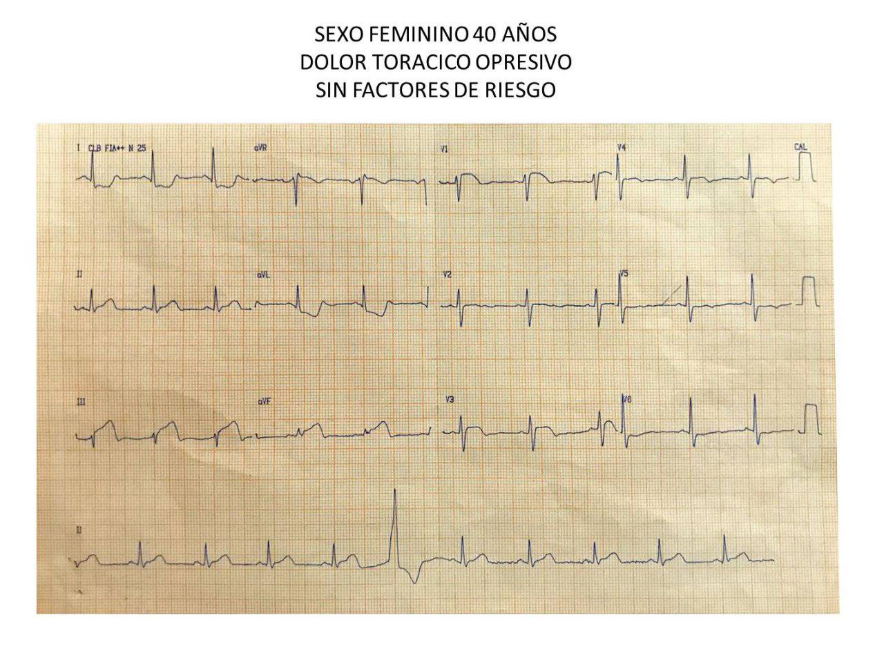 Mujer de 40 años consumidora de cocaína con angor prolongado