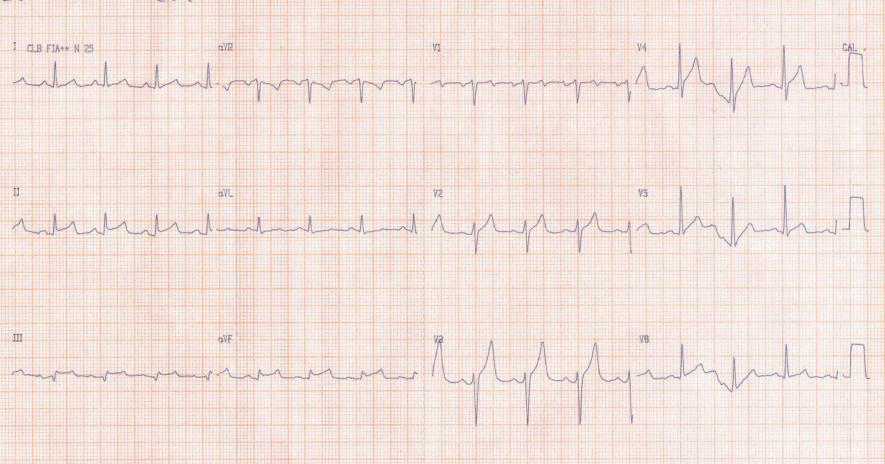 Paciente con factores de riesgo con angor prolongado por SCACEST por compromiso de DA