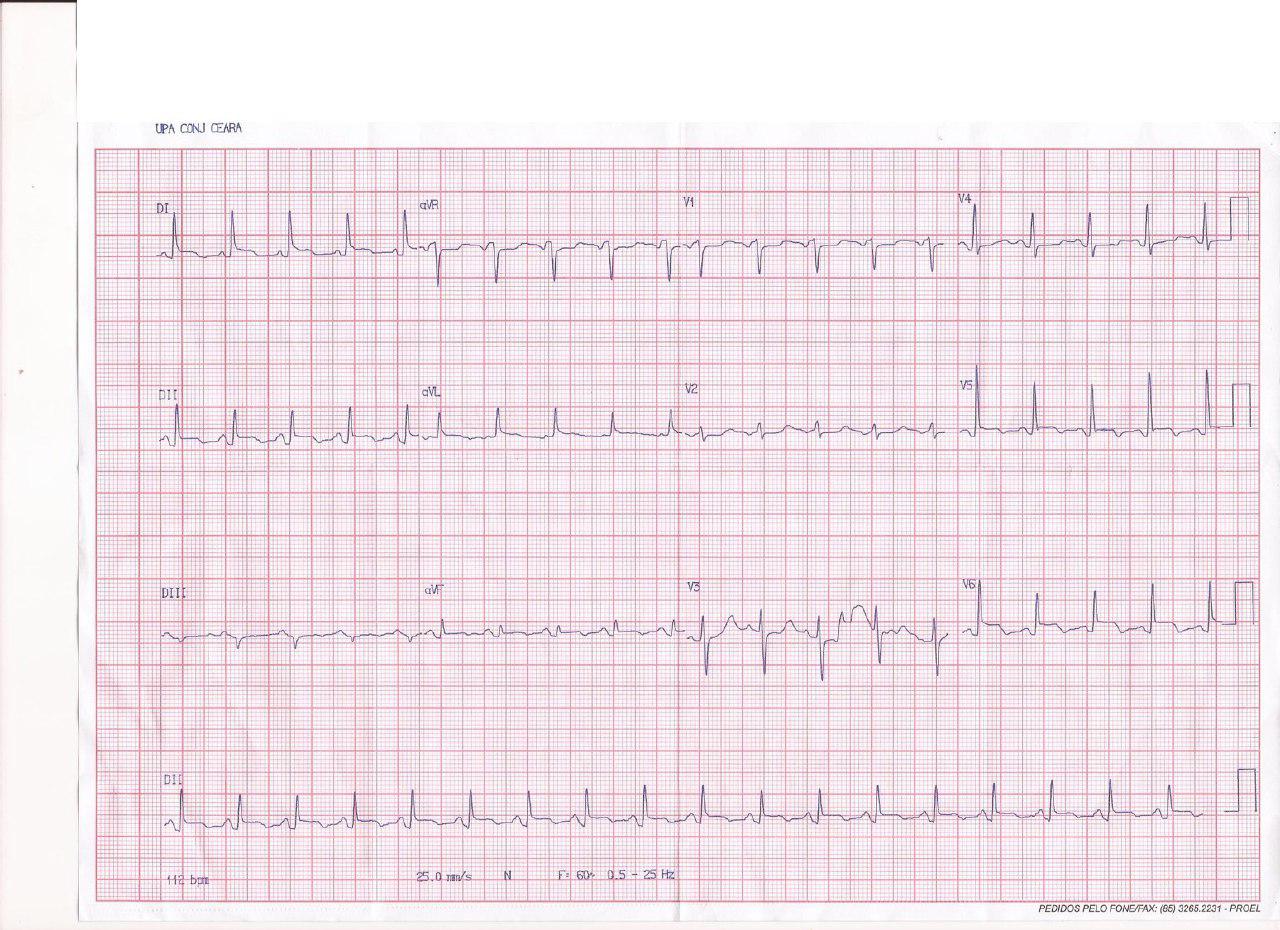 Mujer que luego de episodio gripal cursa con pleuropericarditis aguda