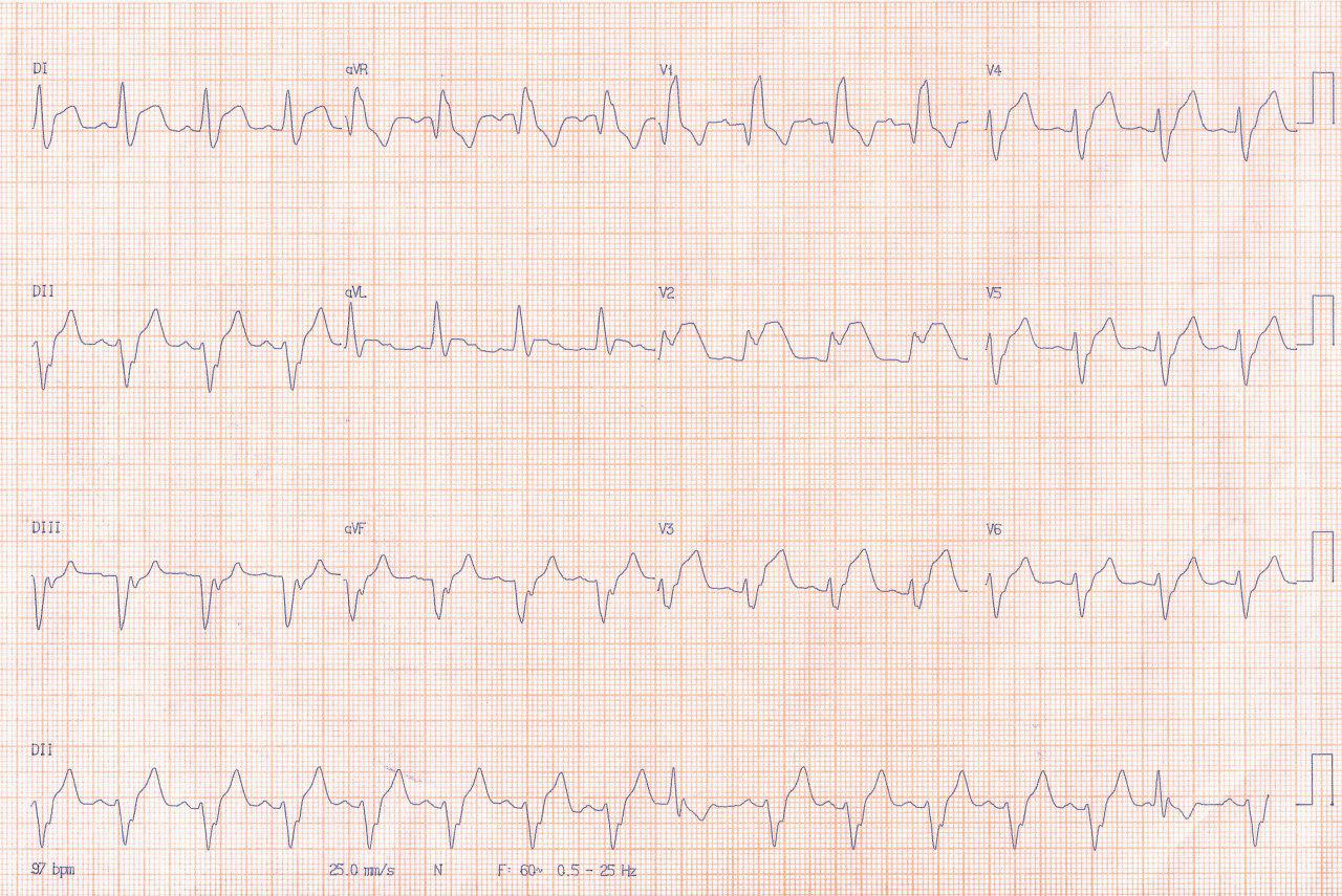 Paciente de 48 años HTA y BDT 2 con SCA por lesión de DA que se angioplastia con fracaso y descompensación metabólica que se corrige