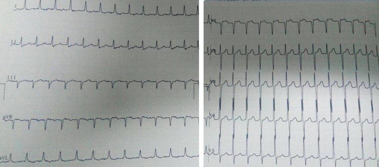 Paciente masculino con palpitaciones en cuello por TRIN