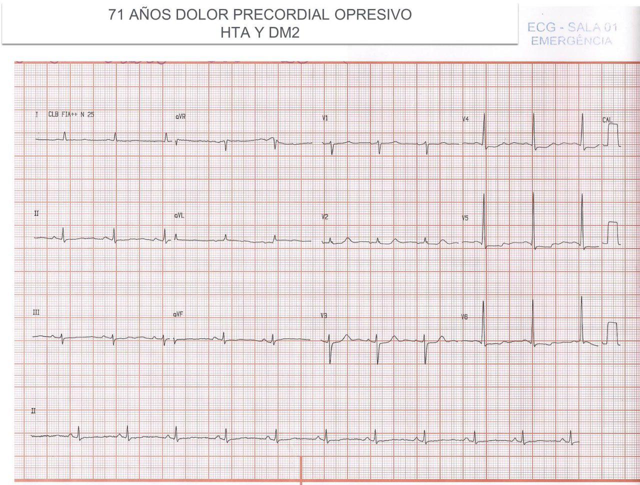 Paciente de 71 años con SCA por lesión de Cx que presenta arritmia SV