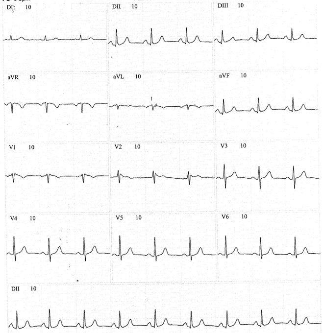 Médica de 56 años asintomática, con patrón Brugada tipo 2