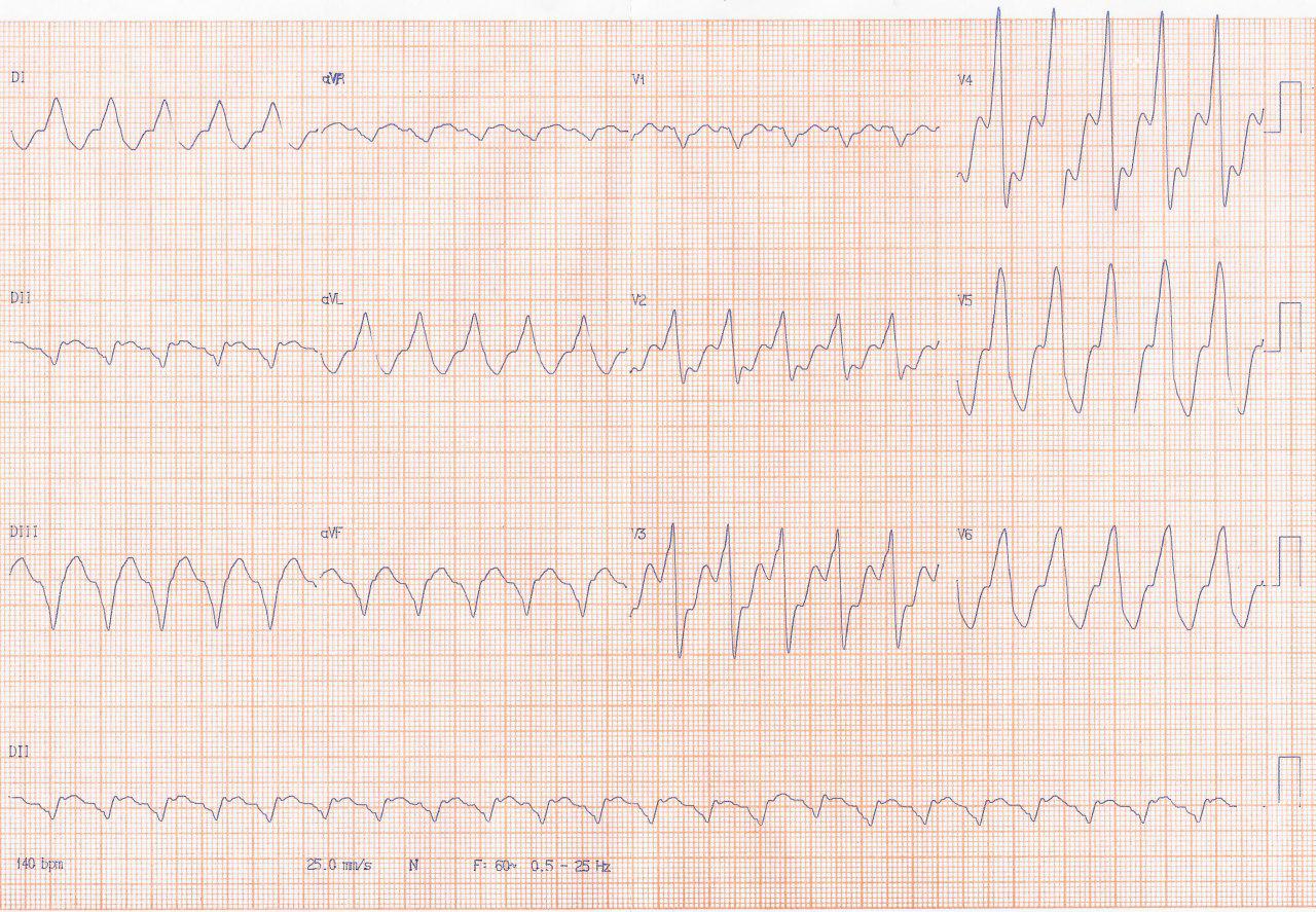 Paciente de 67 años con antecedente de cirugía de RC en 2005 y ACV en 2016