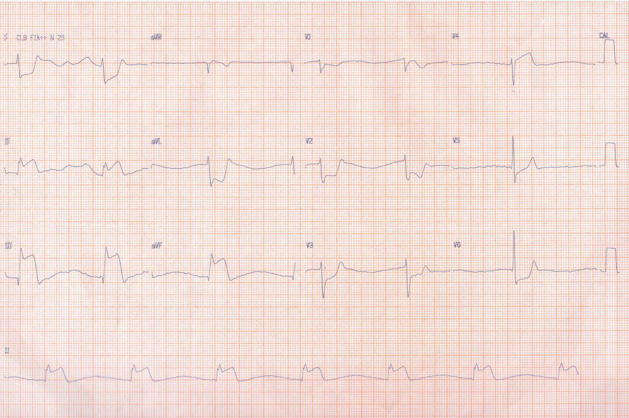 Paciente de 51 años con SCA por oclusión de CD y enfermedad severa de tres vasos