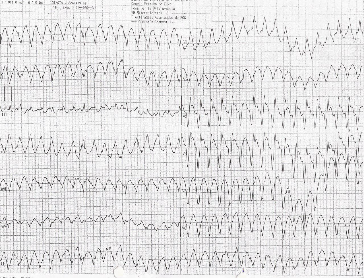 Hombre de 65 años con FR  y SCACEST en 2009 que ingresa con TV que requiere CVE y posterior aneurismectomía