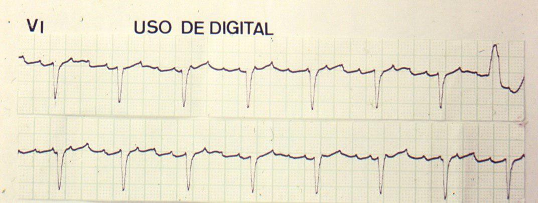 Paciente con aleteo auricular 4:1 por intoxicación digitálica