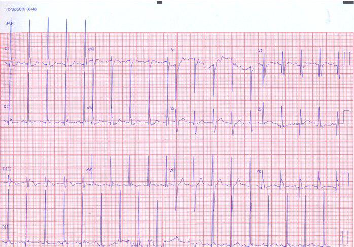 Disnea súbita después de implante de MP bicameral con inestabilidad hemodinámica