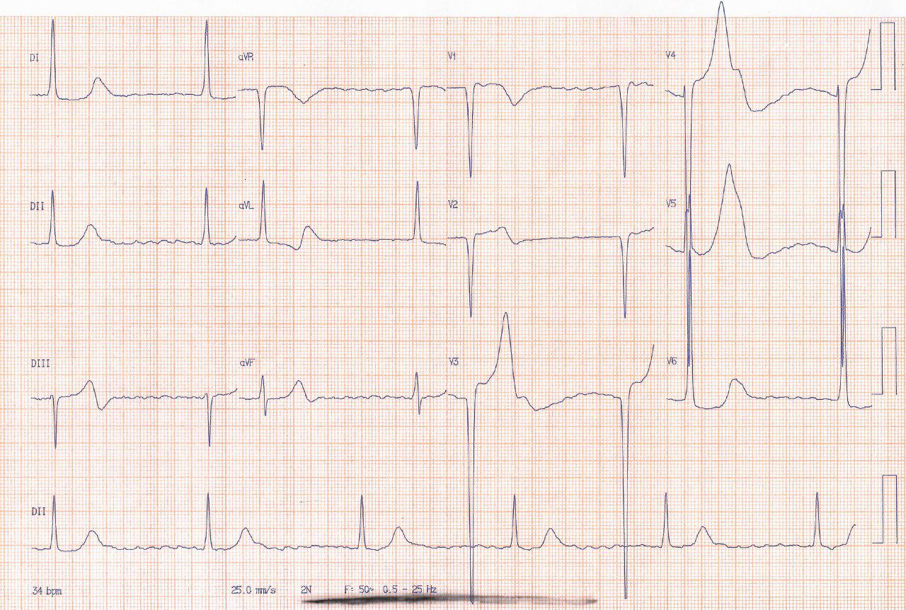Enfermedad de Lev en paciente que presentó episodio sincopal por FA y BAVC