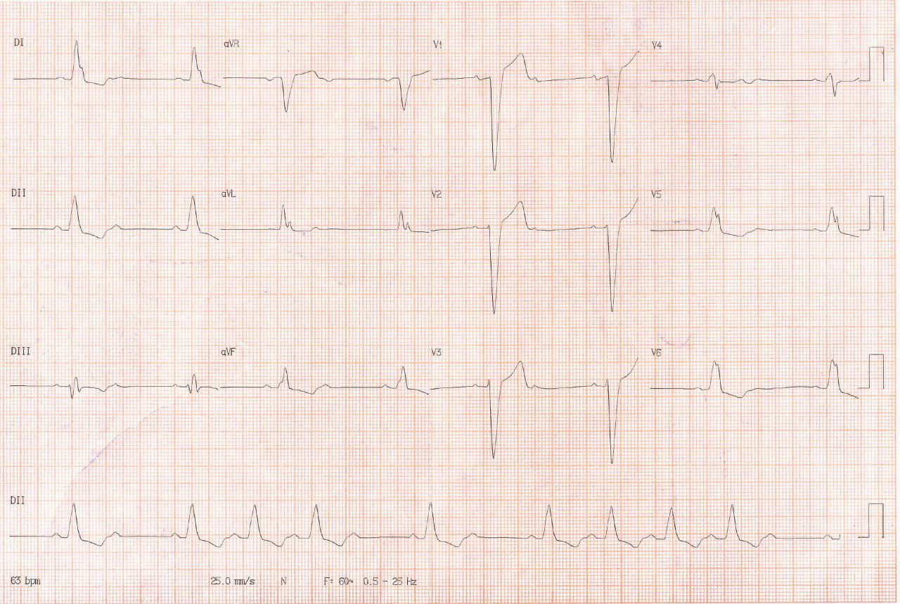 Mujer de 49 años en IRC dialítica con disnea y angor, presenta severo trastorno de conducción