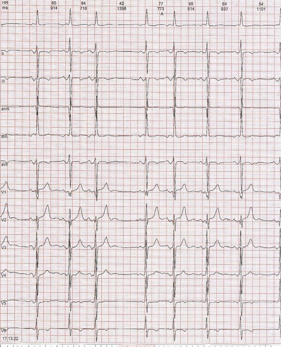 Mujer de 96 años tratada con betabloqueante y rivaroxaban por Síndrome de Bayés
