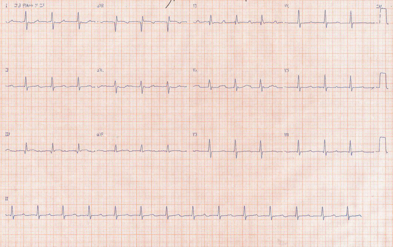 Regla de Harold Bix en TPSV en mujer de 41 años con palpitaciones