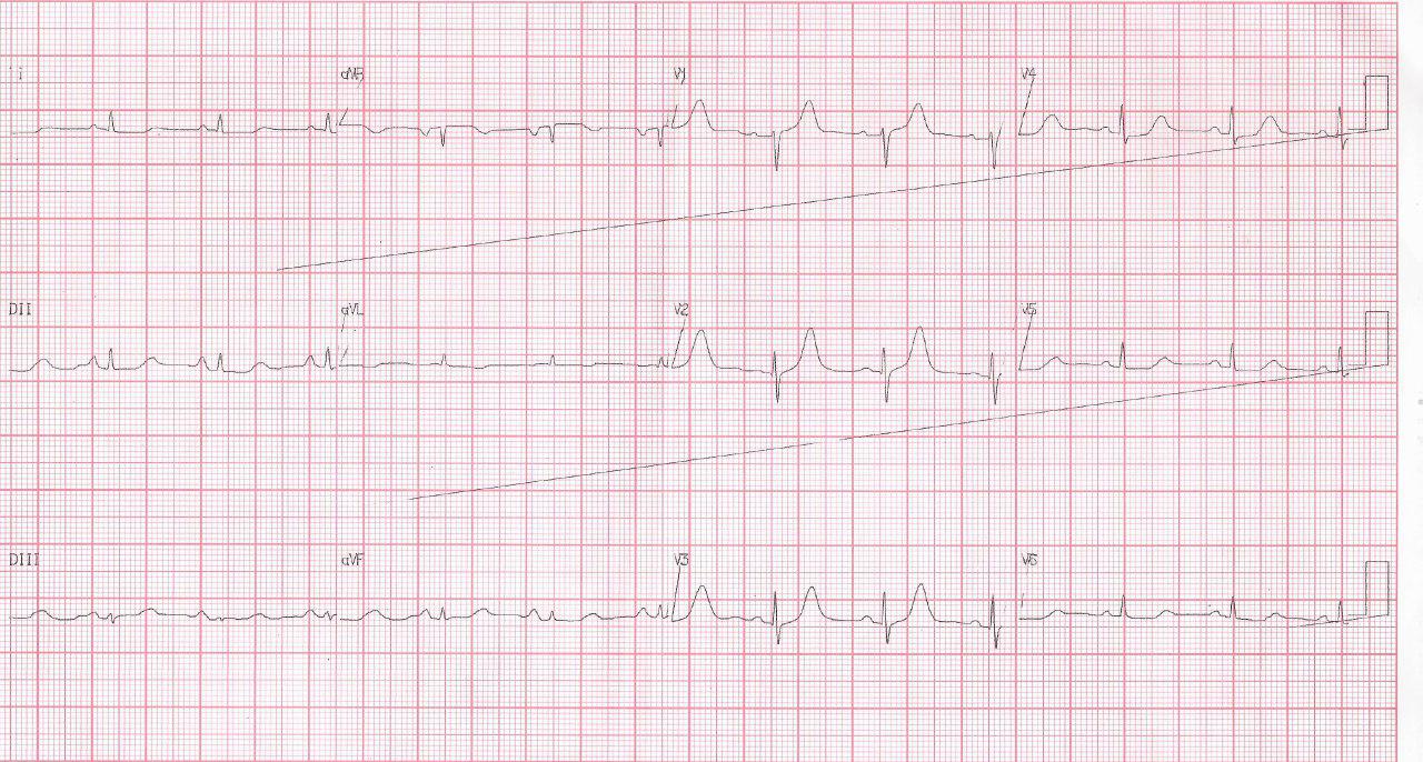 Mujer con factores de riesgo y angor prolongado