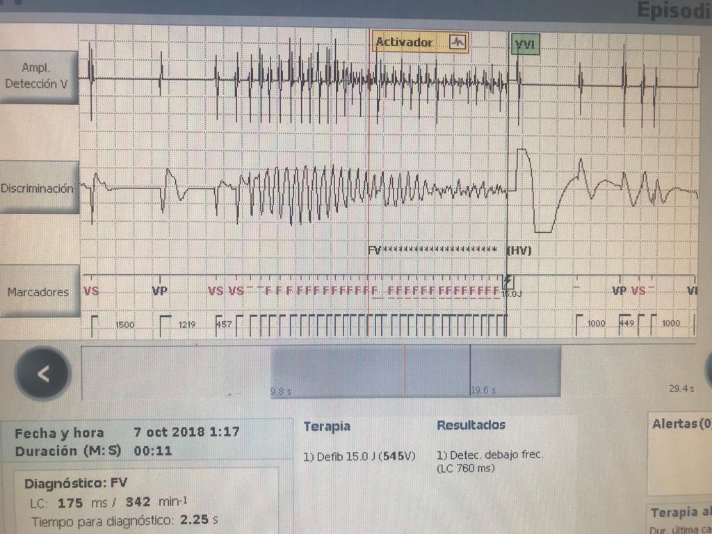 Imagen de CDI implantado en joven de 30 años con Síndrome de Brugada con detección de FV y choque exitoso