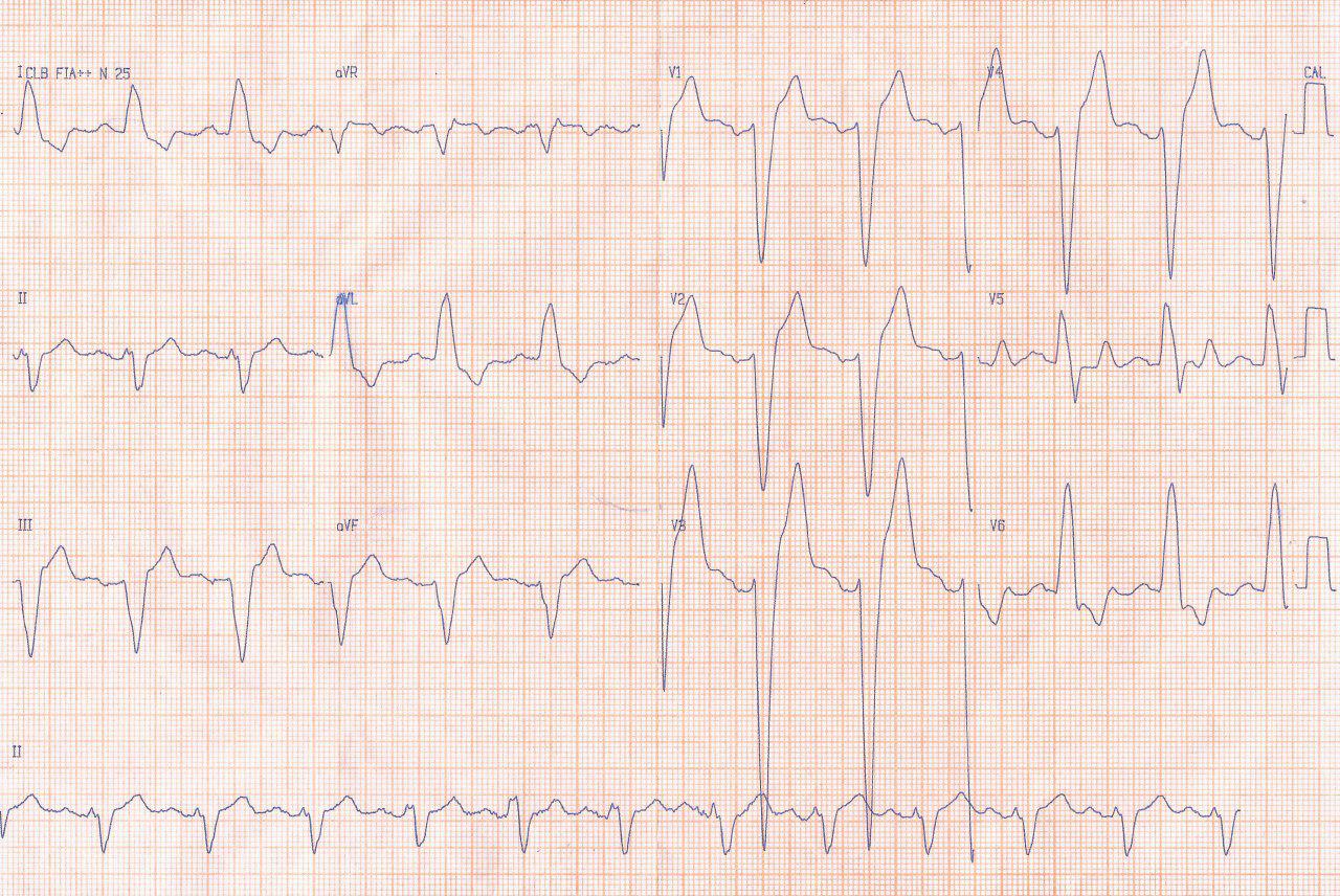 Paciente de 70 años con dolor opresivo precordial sin aunmento de troponina que presenta dilatación de cavidades y que en ECG 2 muestra ondas T electrotónicas