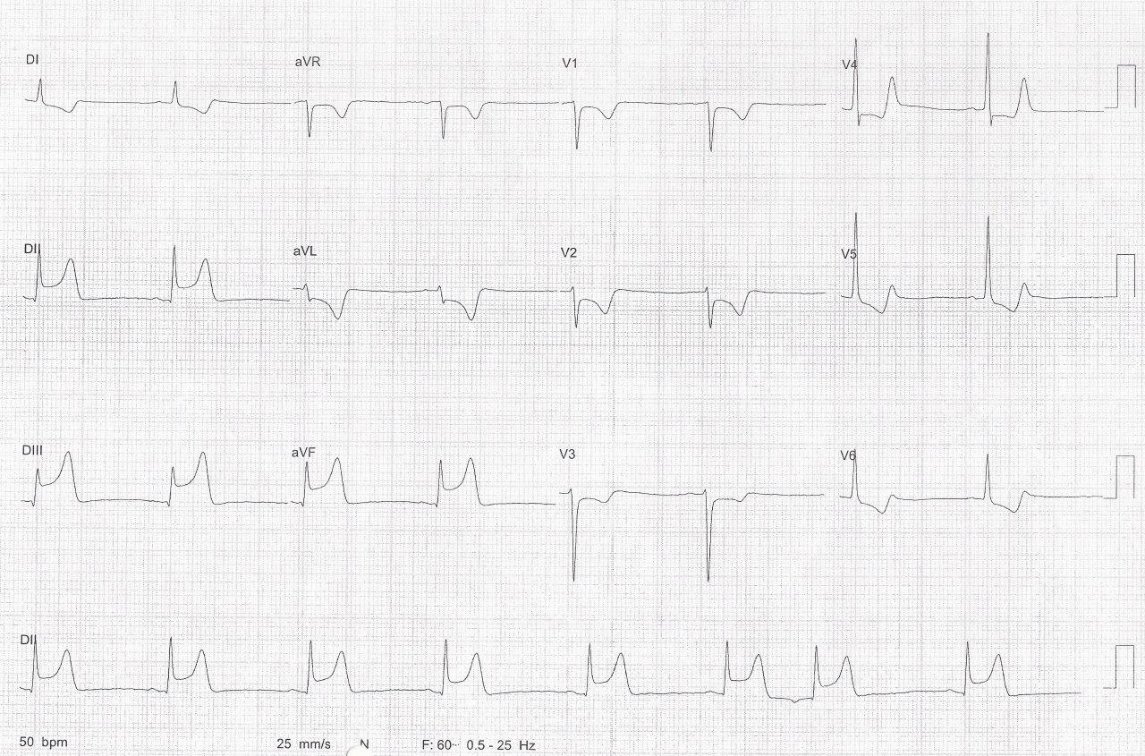 Hombre de 59 años con FR que presenta angor prolongado y se constata IAM con arterias coronarias normales