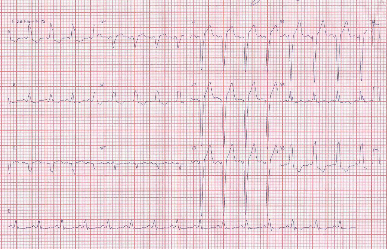 Trazados correspondientes a un paciente con estenosis aórtica severa con gradiente VI – Ao de 100 mm de Hg