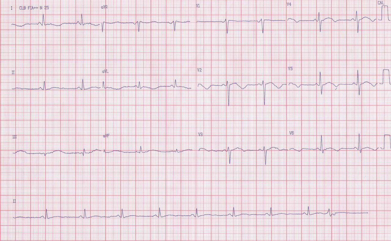 Mujer de 47 años consumidora de alcohol y crack con síncope. Presenta QT largo adquirido y severa hipopotasemia