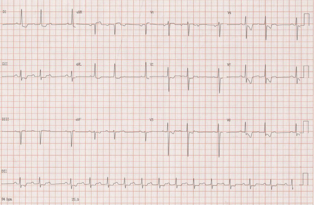Paciente joven en tratamiento por insuficiencia cardíaca presenta BAV tipo Wenckebah por intoxicación digitálica