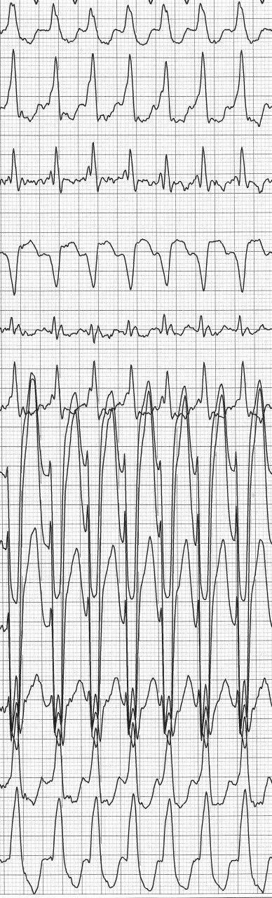 Holter de 12 derivaciones de joven con palpitaciones por presentar FA preexitada