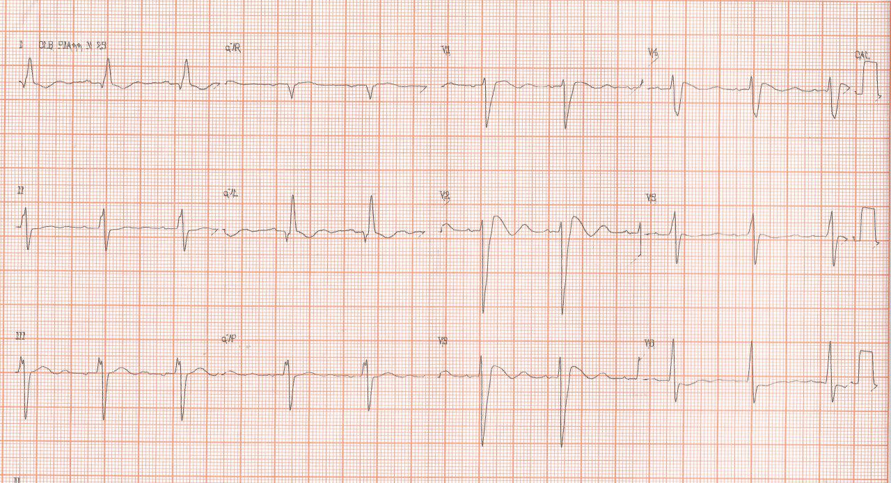 Dos pacientes tratados con azitromicina por infecciones respiratorias