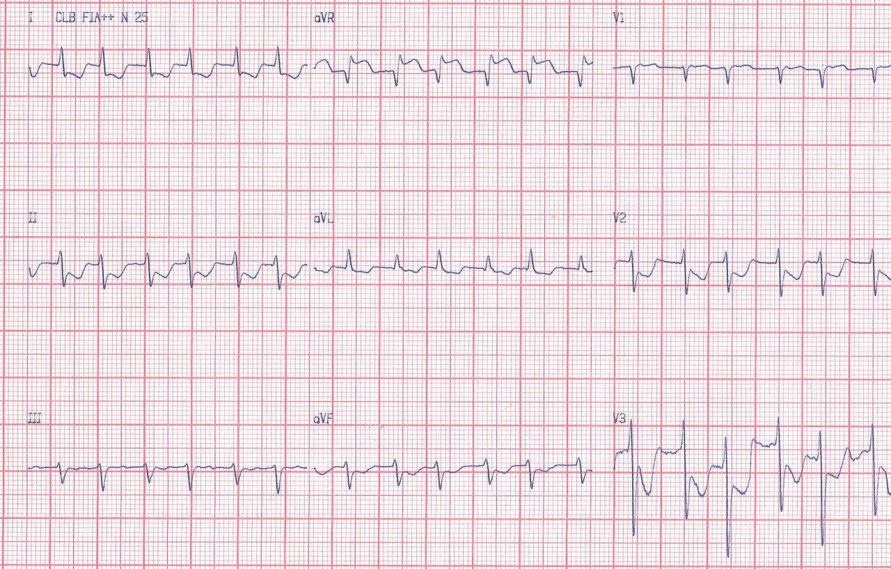 Taquicardia de QRS angosto que no responde al tratamiento por doble vía nodal