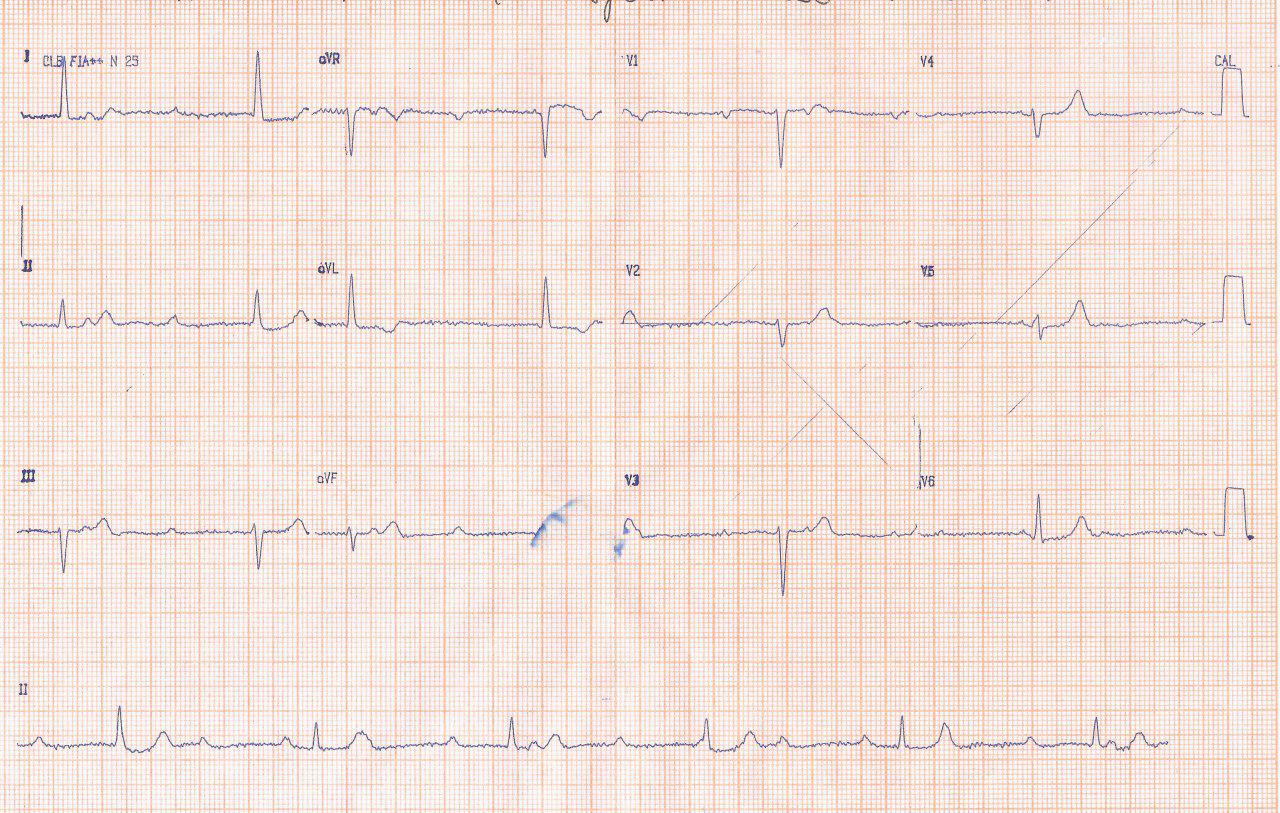 Mujer de 76 años con disnea y episodio sincopal