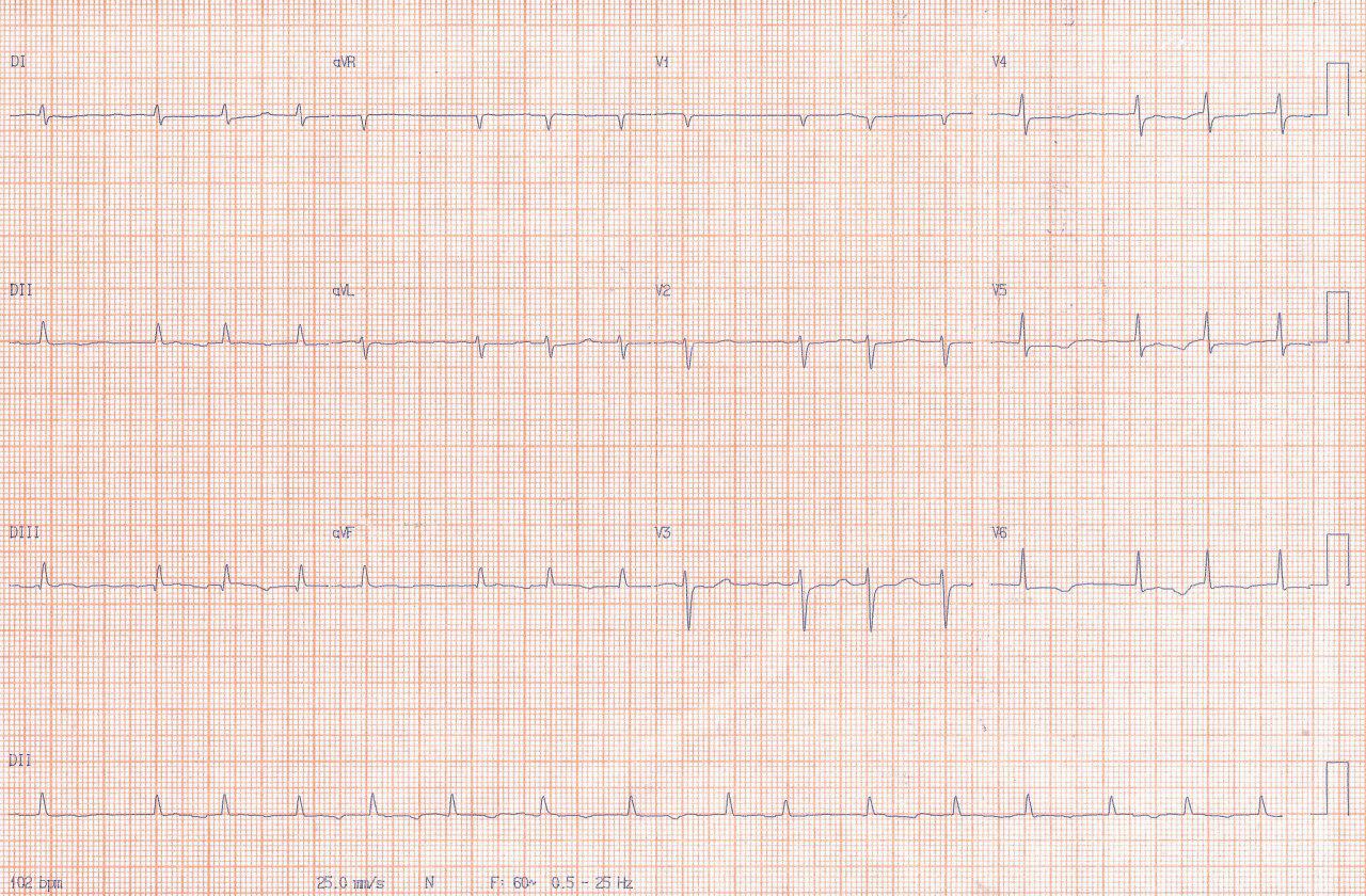 Mujer de 75 años con múltiples factores de riesgo presenta FA y angor prolongado por embolia coronaria que requiere aspiración de trombo y stent