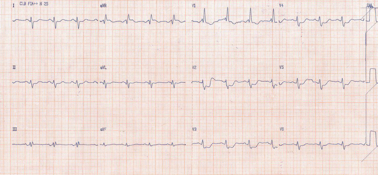 Masculino de 55 años con angor prolongado por SCA por compromiso  de Cx y lesiones crónicas en DA