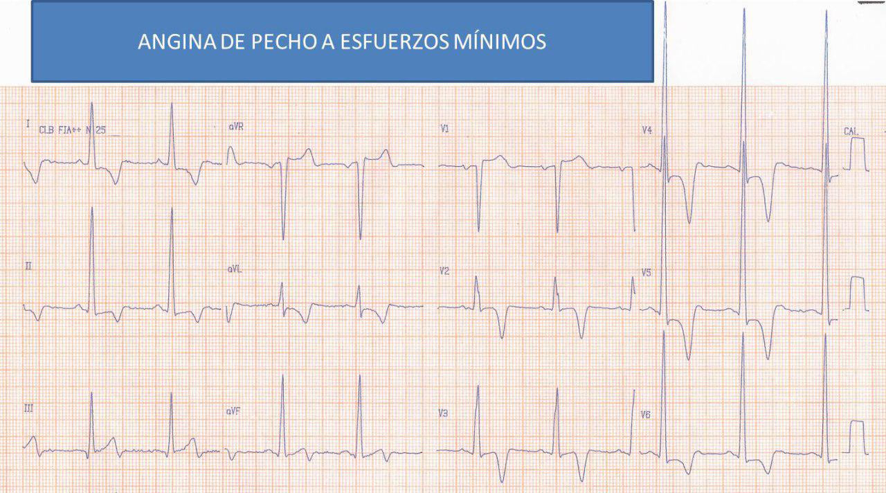 Paciente de 45 años que presenta angor debido a miocardiopatía hipertrófica obstructiva dinámica