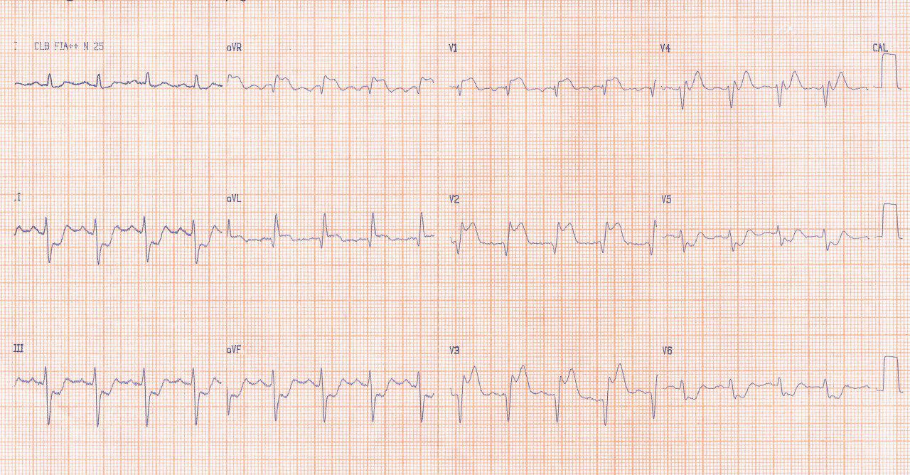 Síndrome coronario agudo en hombre de 70 años por severas lesiones proximales en DA y Cx, simil Tronco de CI