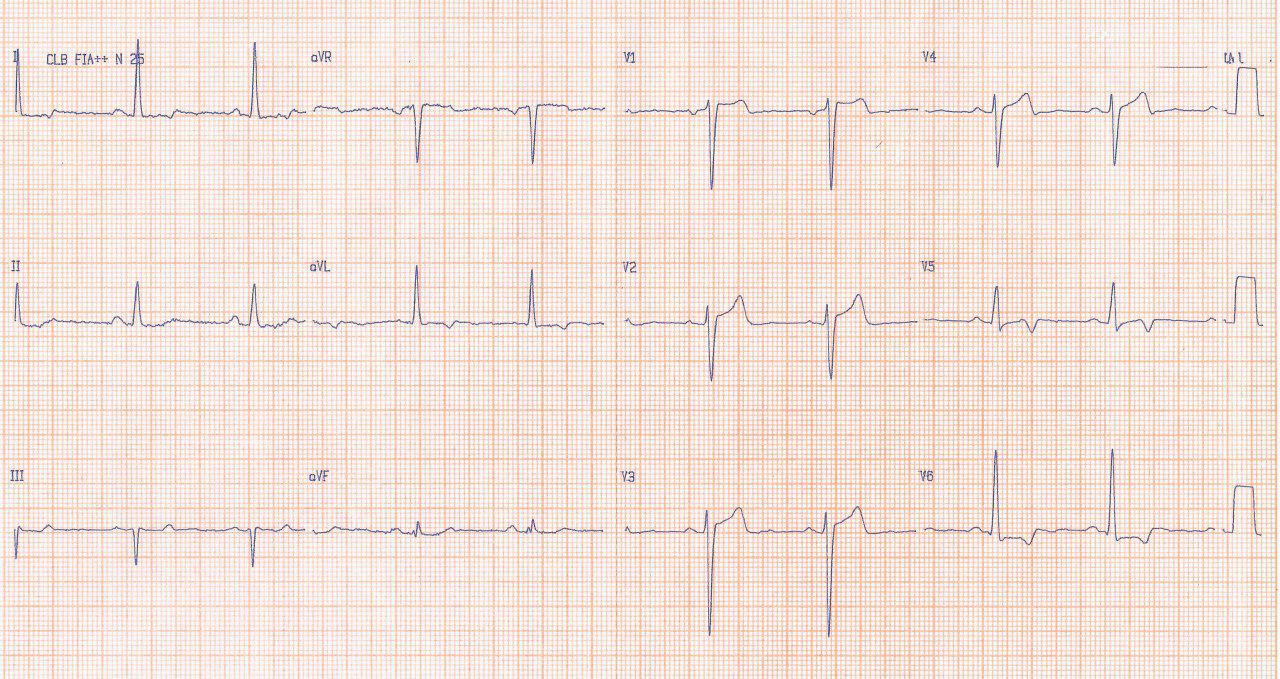 Paciente de 71 años con angor y disnea progresivos portador de estenosis aórtica y lesión severa suboclusiva de DA