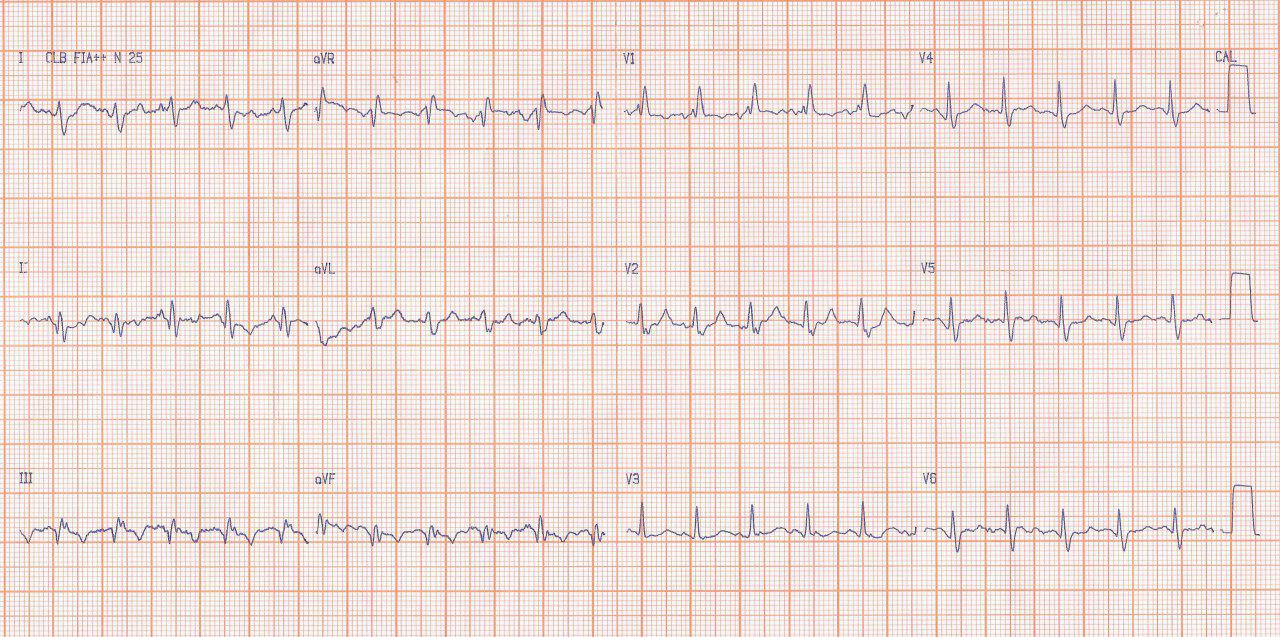 Mujer de 56 años con cuadro de precordialgia y disnea súbitos por tromboembolismo pulmonar