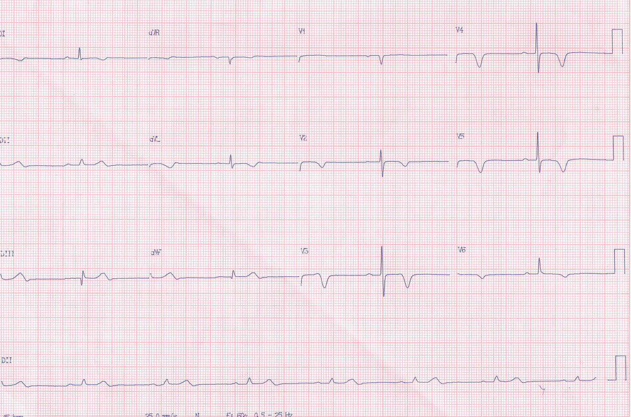 Masculino de 75 años hipertenso y diabético no tratado con dolor intenso y parestesias en MSI por disección aórtica que lleva al óbito