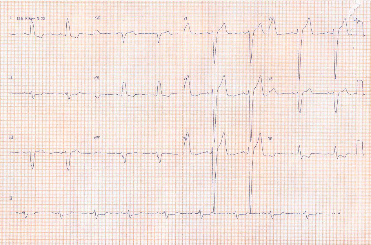 Paciente de 69 años diabético y con antecedente de by pass Ao-coronario hace 7 años que presenta episodio sincopal
