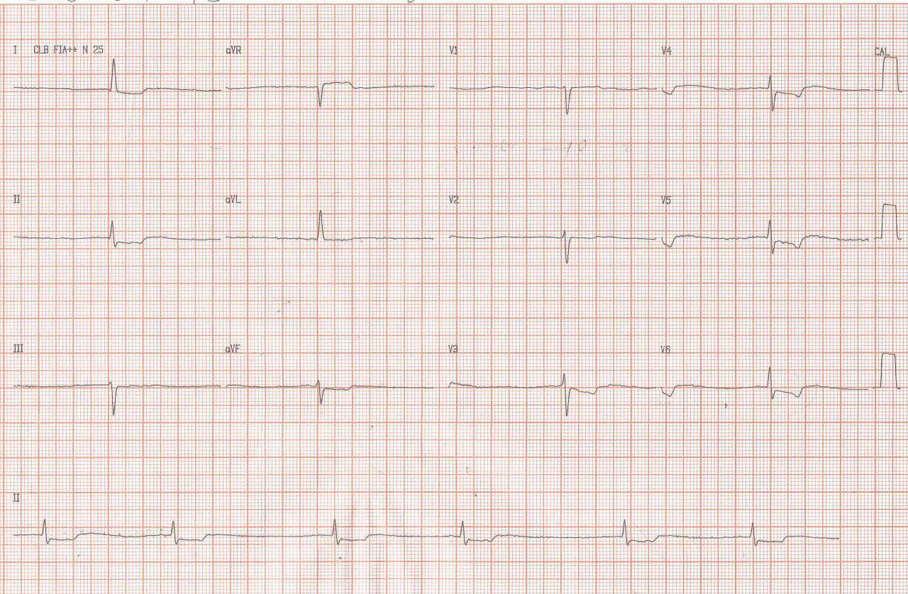 Mujer con intoxicación digitálica con disnea, anorexia y debilidad