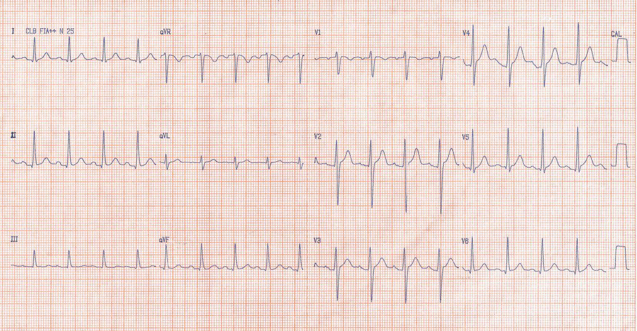 Masculino de 21 años con episodios sincopales por BAVC paroxístico