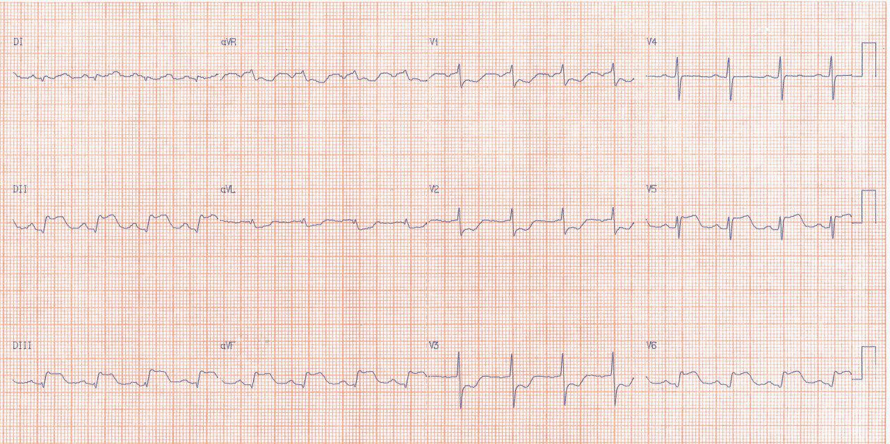 Mujer de 52 años con angor prolongado por oclusión de Cx que se angioplastia y se reocluye con ruptura externa, hemopericardio y óbito
