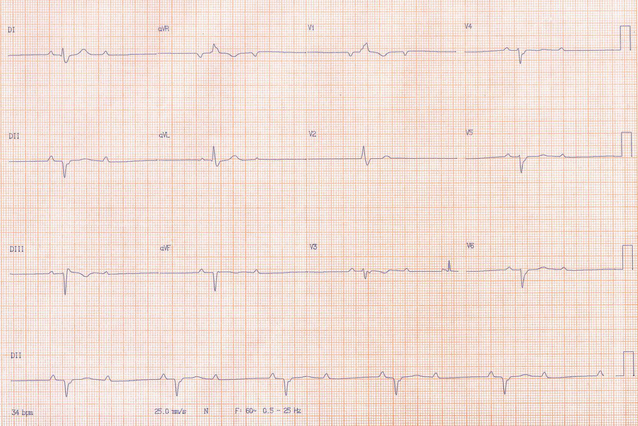 Masculino de 80 años con enfermedad coronaria multivasos que presenta episodios sincopales