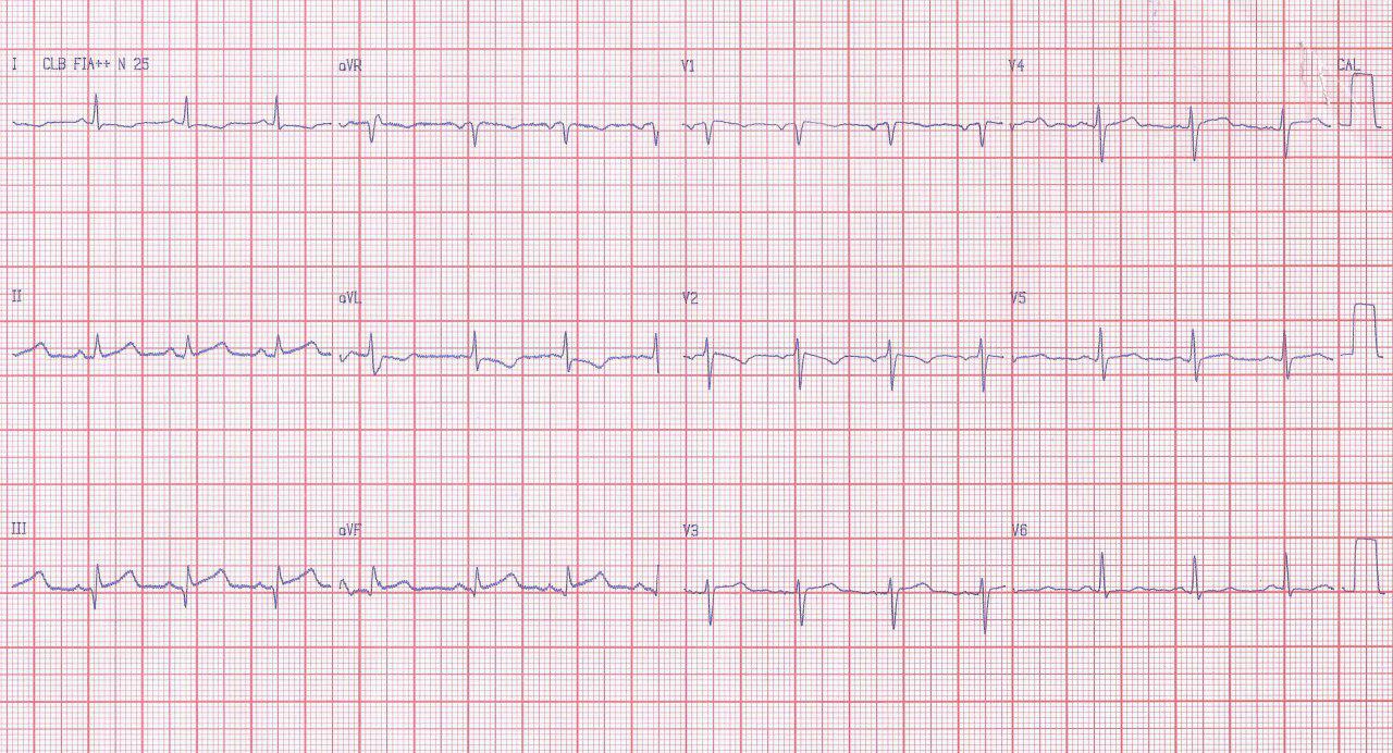 Mujer de 59 años con angor prolongado y antecedentes de cirugía de by pass con puente de safena a la CD  que se encuentra ocluída