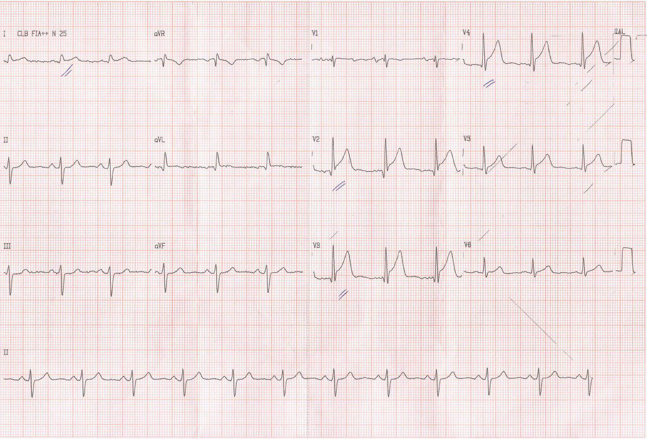 Paciente con factores de riesgo que cursa SCACEST y es angioplastiado con fracaso del peocedimiento