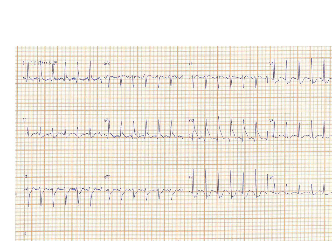 Paciente de 31 años que presenta ondas Lambda en el ECG por hemorragia subaracnoidea