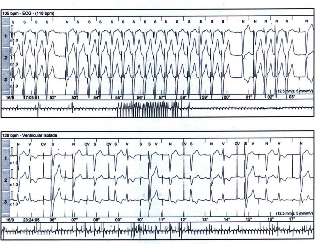 Taquicardia de marcapasos con fenómeno de tracking
