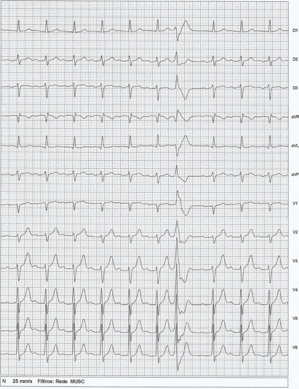 ECG post ablación de FA en paciente portador de síndrome de Bayés con BIA-A avanzado