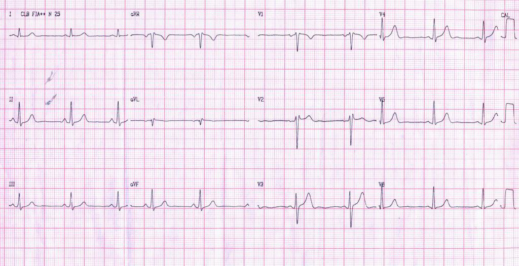 Paciente de 29 años longilíneo, asintomático, en el que se descarta síndrome de Brugada