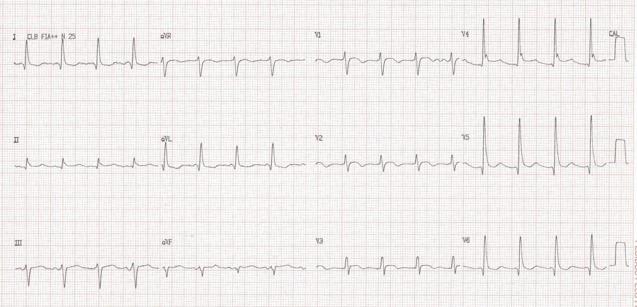Paciente con ICC descompensada muestra patrón de repolarización precoz maligna que presenta episodio de FV